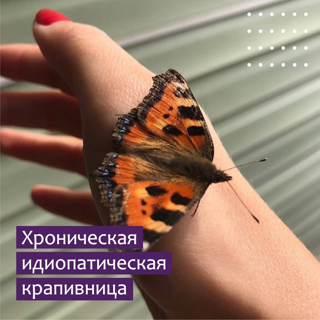 Хроническая идиопатическая крапивница